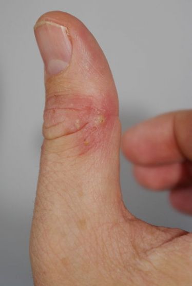DON'T BLAME SPIDERS -- Researchers say that this is not the proverbial "spider bite." PHOTO: WIKIPEDIA